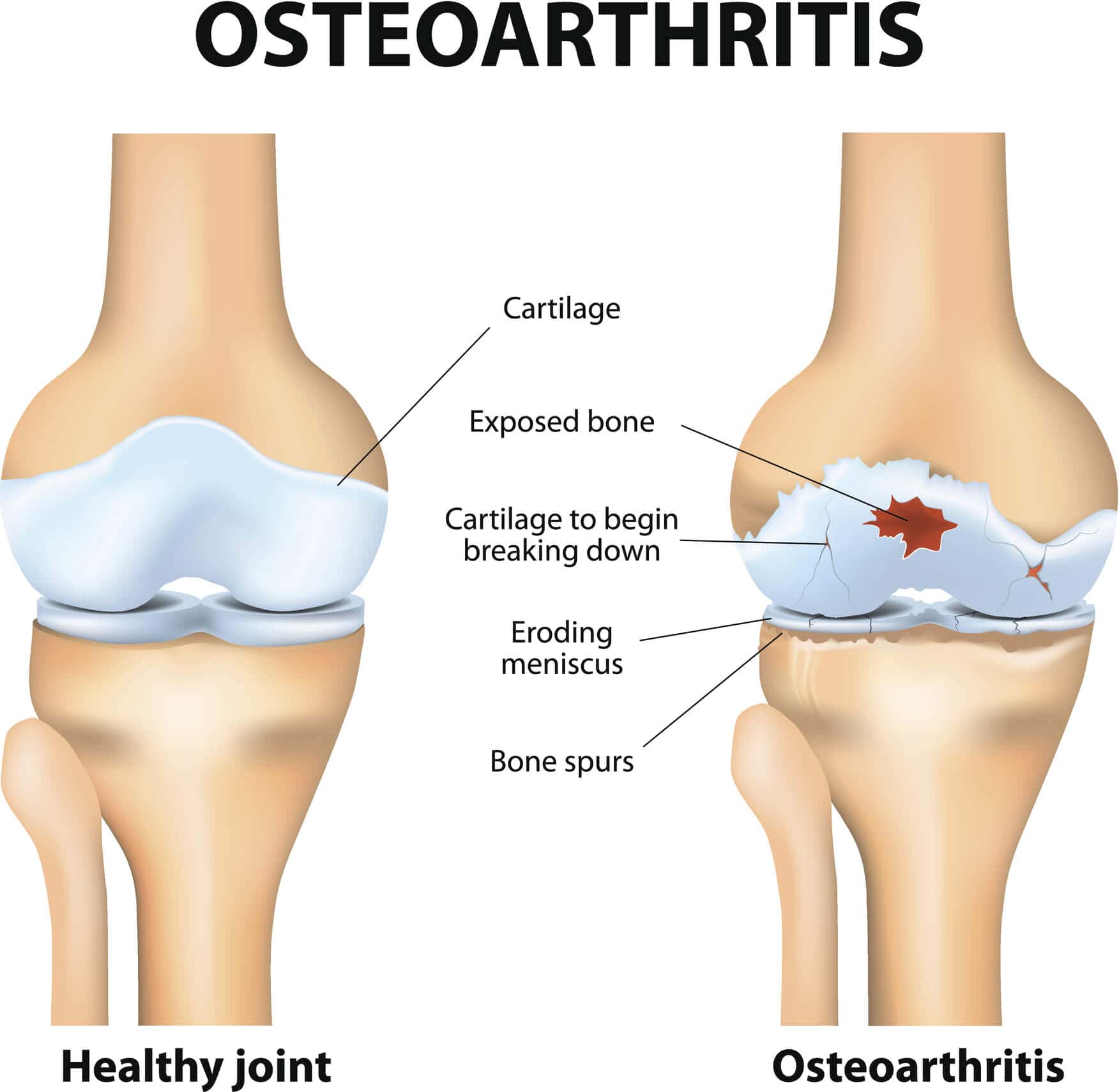 stop-and-reverse-osteoarthritis-by-following-these-2-simple-tips