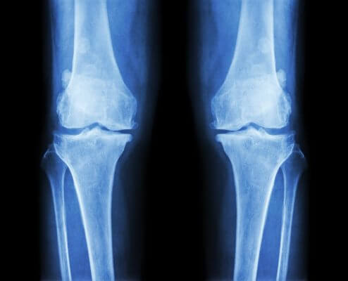 How To Decrease Risk of Osteoarthritis With 2 Simple Changes