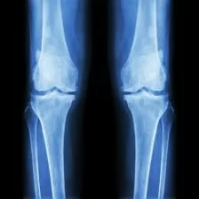 How To Decrease Risk of Osteoarthritis With 2 Simple Changes