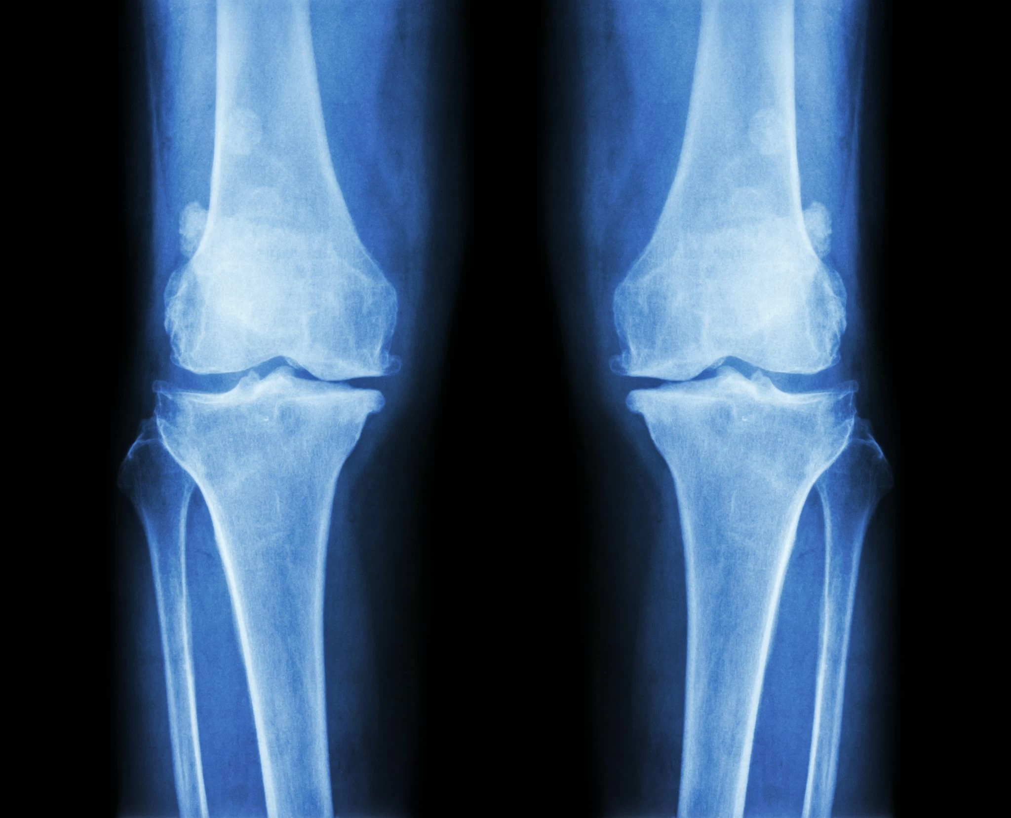 How To Decrease Risk of Osteoarthritis With 2 Simple Changes